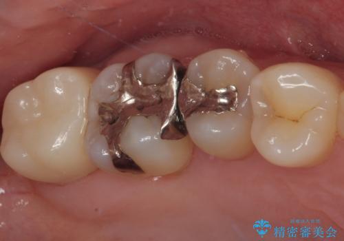 矯正治療で移動を終えた歯 オールセラミッククラウンでのむし歯治療の症例 治療後