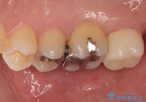 矯正治療で移動を終えた歯 オールセラミッククラウンでのむし歯治療の治療後