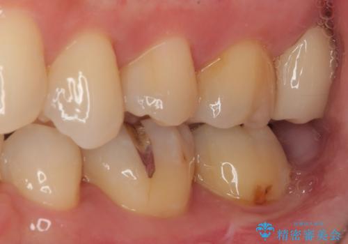 矯正治療で移動を終えた歯 オールセラミッククラウンでのむし歯治療の治療後