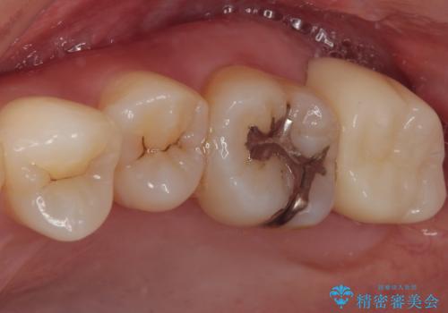 矯正治療で移動を終えた歯 オールセラミッククラウンでのむし歯治療の治療後