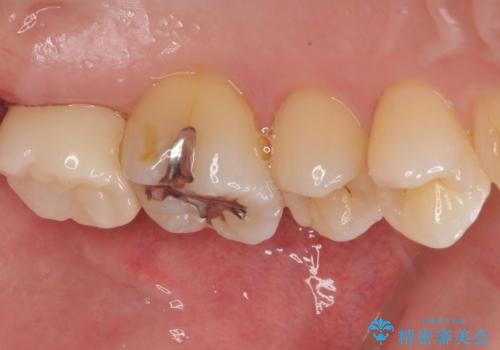 矯正治療で移動を終えた歯 オールセラミッククラウンでのむし歯治療の治療後