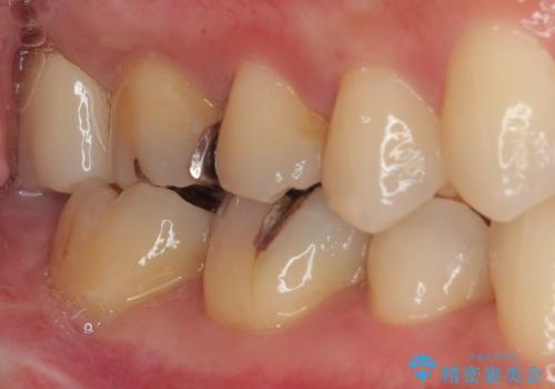 矯正治療で移動を終えた歯 オールセラミッククラウンでのむし歯治療の治療後