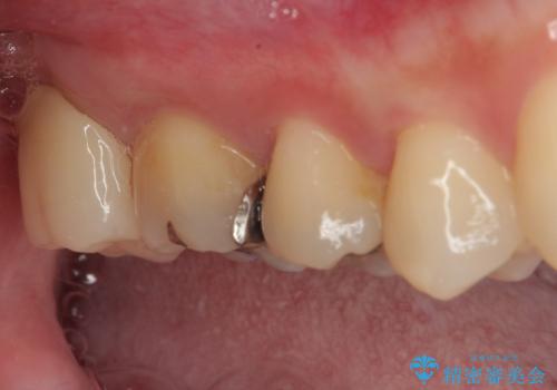 矯正治療で移動を終えた歯 オールセラミッククラウンでのむし歯治療の治療後