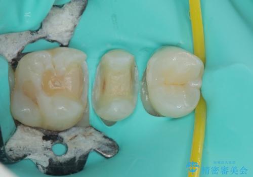 右上の銀歯を外したい ハイブリッドインレー修復の治療中