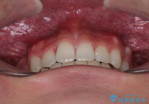 前歯のデコボコと正中のずれを改善!白い装置で目立たない矯正の治療後