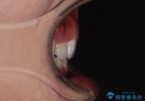 前歯のデコボコと正中のずれを改善!白い装置で目立たない矯正の治療後