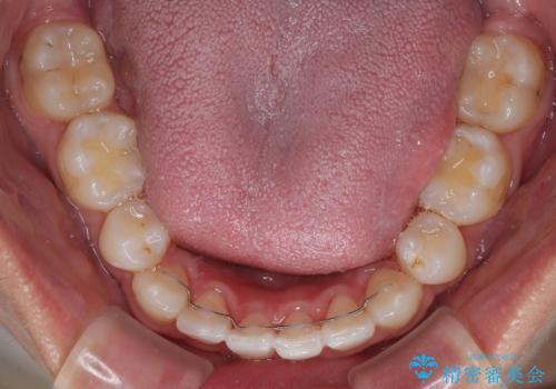 前歯のデコボコと正中のずれを改善!白い装置で目立たない矯正の治療後