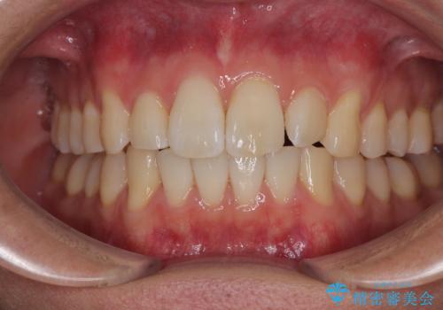 前歯のデコボコをインビザラインで綺麗に改善の症例 治療後