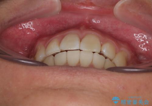 前歯のデコボコをインビザラインで綺麗に改善の治療後