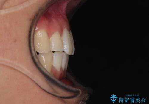 前歯のデコボコをインビザラインで綺麗に改善の治療後
