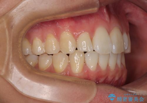 前歯のデコボコをインビザラインで綺麗に改善の治療後