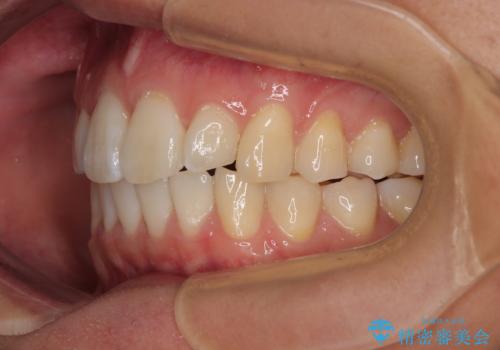 前歯のデコボコをインビザラインで綺麗に改善の治療後