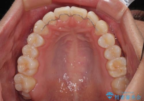 前歯のデコボコをインビザラインで綺麗に改善の治療後