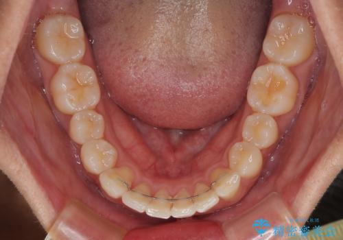 前歯のデコボコをインビザラインで綺麗に改善の治療後