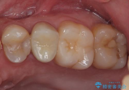左上に違和感がある セラミックインレー修復の症例 治療後