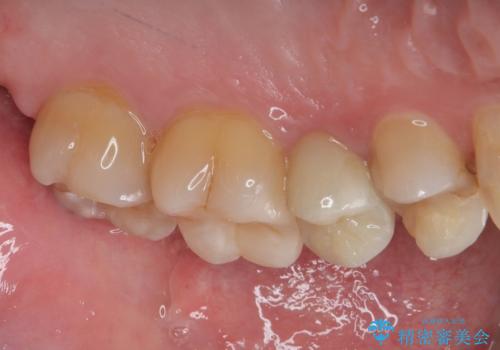 左上に違和感がある セラミックインレー修復の治療後