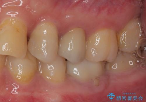 左上に違和感がある セラミックインレー修復の治療後