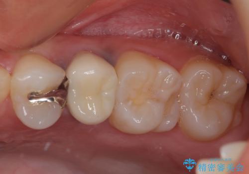 笑った時に目立つ銀歯を治したい オールセラミッククラウンの症例 治療後