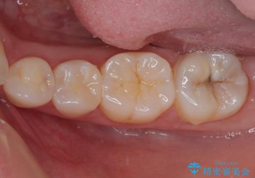 左下に虫歯が見つかった セラミックインレー修復の治療後
