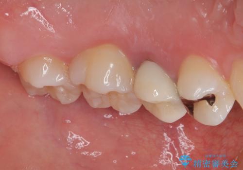 笑った時に目立つ銀歯を治したい オールセラミッククラウンの治療後