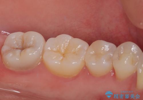 左下に虫歯が見つかった セラミックインレー修復の治療後
