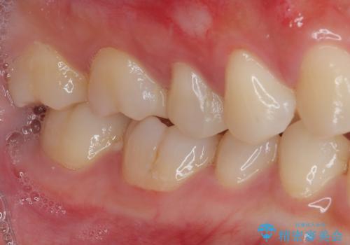 右上の銀歯を外したい ハイブリッドインレー修復の治療後