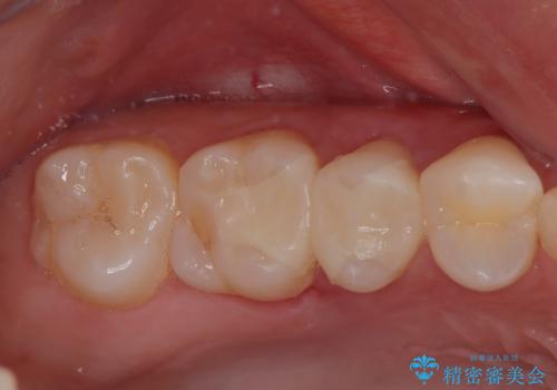 右上の銀歯を外したい ハイブリッドインレー修復の症例 治療後