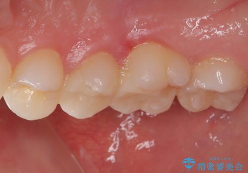 右上の銀歯を外したい ハイブリッドインレー修復の治療後