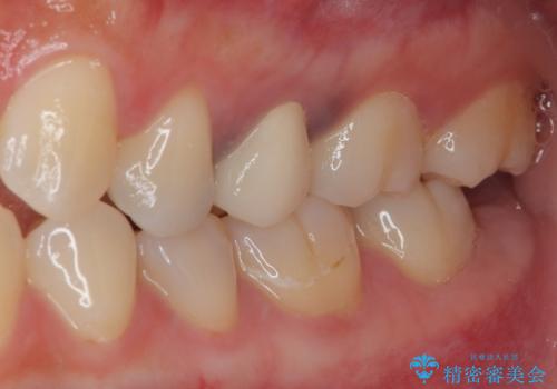 笑った時に目立つ銀歯を治したい オールセラミッククラウンの治療後