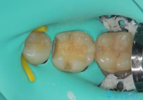 セラミックに取り替えたい セラミックインレー修復の治療中