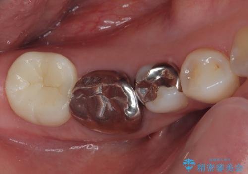 右下の銀歯が外れた オールセラミッククラウンの症例 治療後