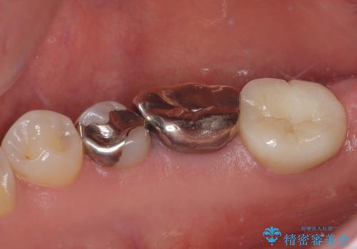 右下の銀歯が外れた オールセラミッククラウンの治療後