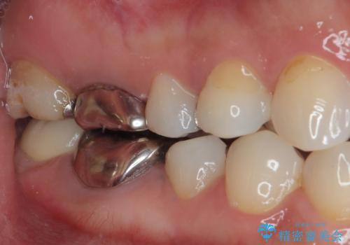 右下の銀歯が外れた オールセラミッククラウンの治療後