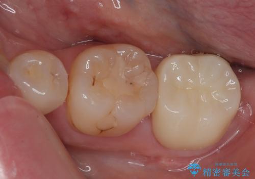 左下の奥歯が欠けた フルジルコニアクラウン・親知らず抜歯の症例 治療後