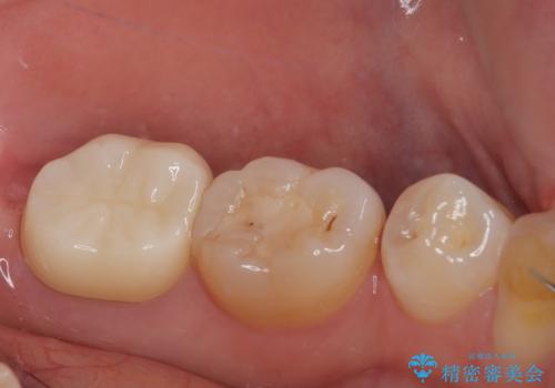 左下の奥歯が欠けた フルジルコニアクラウン・親知らず抜歯の治療後