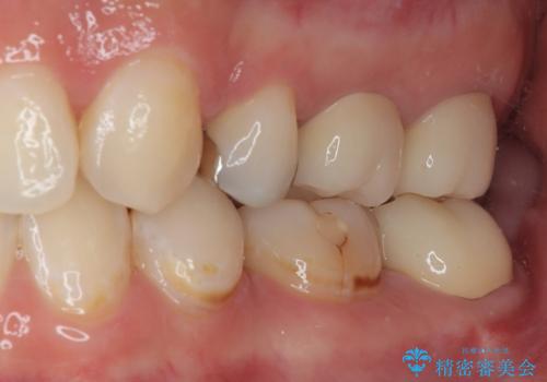 左下の奥歯が欠けた フルジルコニアクラウン・親知らず抜歯の治療後