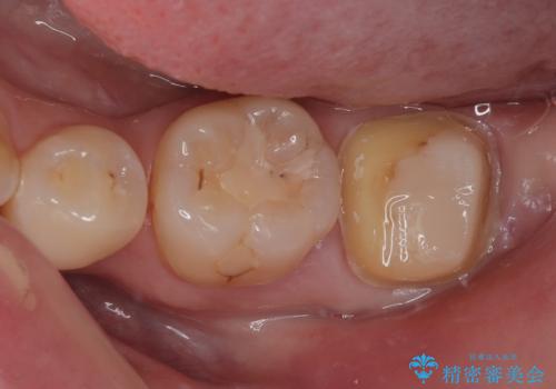 左下の奥歯が欠けた フルジルコニアクラウン・親知らず抜歯の治療中