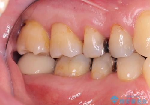 銀歯の下の虫歯|オールセラミッククラウンの治療前