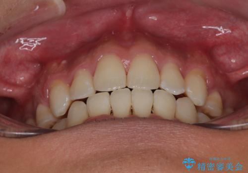 【モニター】前歯のデコボコと口元の出っ張りを改善!目立たない矯正で自然な笑顔にの治療後