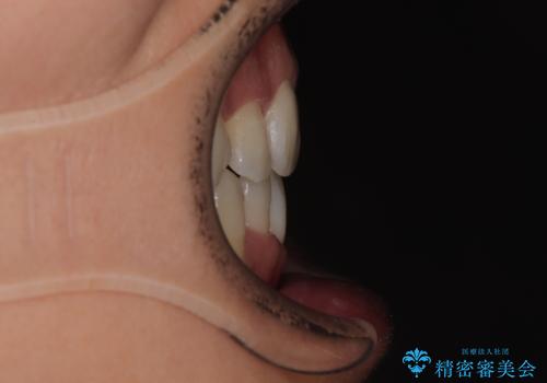 【モニター】前歯のデコボコと口元の出っ張りを改善!目立たない矯正で自然な笑顔にの治療後