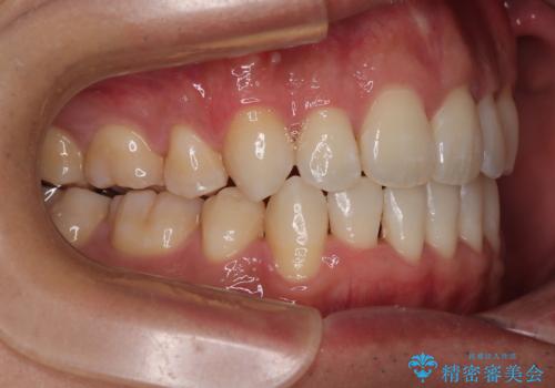 【モニター】前歯のデコボコと口元の出っ張りを改善!目立たない矯正で自然な笑顔にの治療後