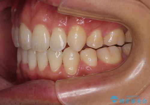 【モニター】前歯のデコボコと口元の出っ張りを改善!目立たない矯正で自然な笑顔にの治療後