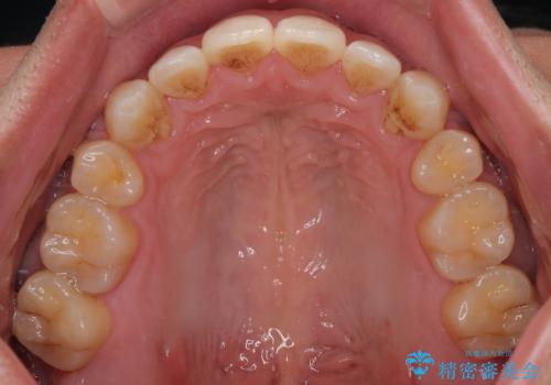 【モニター】前歯のデコボコと口元の出っ張りを改善!目立たない矯正で自然な笑顔にの治療後