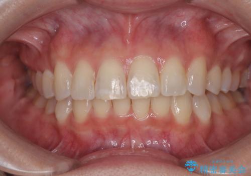 デコボコの非抜歯矯正 ワイヤー装置で楽して改善の症例 治療後