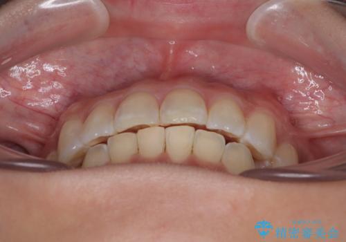 デコボコの非抜歯矯正 ワイヤー装置で楽して改善の治療後