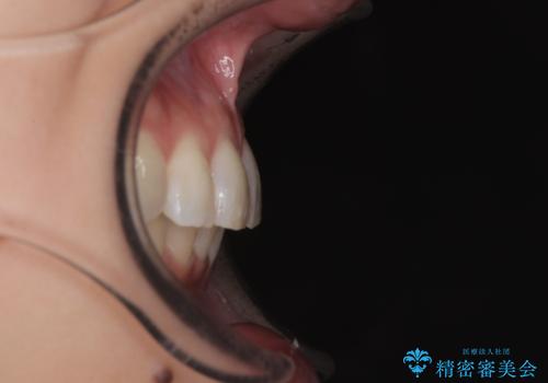 デコボコの非抜歯矯正 ワイヤー装置で楽して改善の治療後