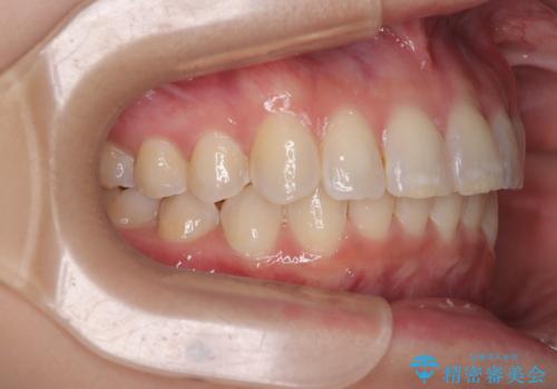 デコボコの非抜歯矯正 ワイヤー装置で楽して改善の治療後