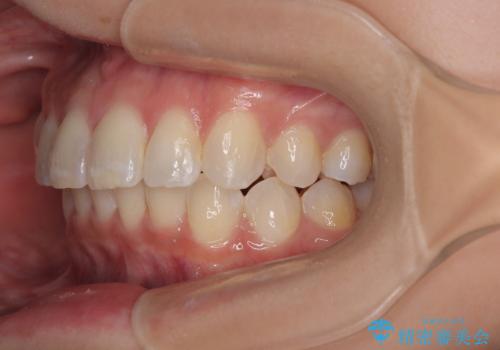 デコボコの非抜歯矯正 ワイヤー装置で楽して改善の治療後