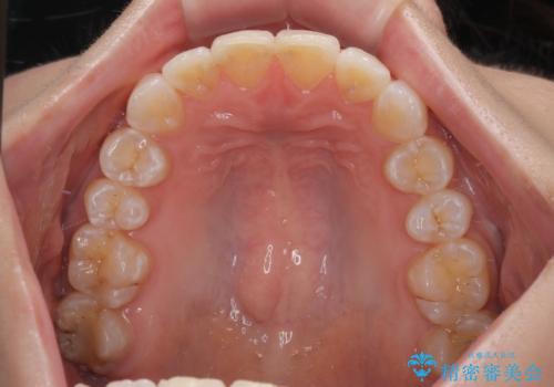 デコボコの非抜歯矯正 ワイヤー装置で楽して改善の治療後