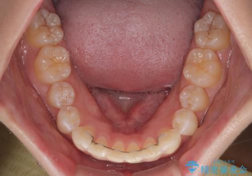 デコボコの非抜歯矯正 ワイヤー装置で楽して改善の治療後
